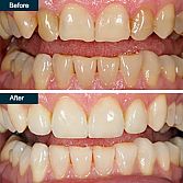 Dental Bonding (cosmetic teeth bonding) Â· Bronx Family Dentistry