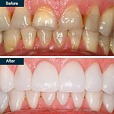 Dental Crown, Teeth Crowns (ceramic, zirconia) â Top Cosmetic Dentist in the Bronx NY