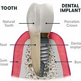 Dental Implants -from $1000 to $4000