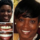 Dental, Teeth Crowns in Brooklyn â Best Cosmetic Dentist