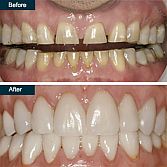 Dental Veneers (press-on teeth veneers) â Top Rated Bronx Dentists