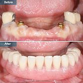 Denture Implants (Dental Implant Dentures) - Top Rated Implant Dentist in Brooklyn