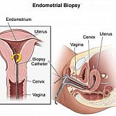 Endometrial, Uterine Biopsy Â· Endometrium Specialist Â· Gynecologist Midtown Manhattan NYC
