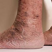 Endovenous Radiofrequency Ablation from Varicose Vein Treatments Center
