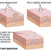 Genital Warts Â· Dermatologist Â· Cosmetic Laser Dermatology NYC