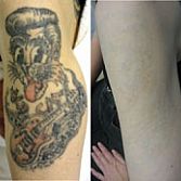 Laser Tattoo Removal | Midtown NYC