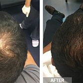PRP FOR HAIR LOSS IN BROOKLYN NY | PRP HAIR TREATMENT