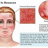 Rosacea Â· Manhattan Dermatologist Â· Cosmetic, Laser Dermatology in NYC