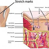 Stretch Marks Â· Dermatologist Â· Cosmetic Laser Dermatology NYC