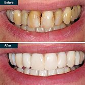 Teeth Cleaning (painless dental deep cleaning)