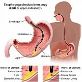 Upper Endoscopy Doctor NYC Gastroenterologist | NYC Endoscopy GI Doctor