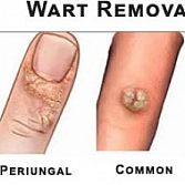 Wart Removal Specialist Â· Dermatologist Â· Cosmetic, Laser Dermatology NYC